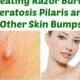 8 Remèdes naturels pour traiter la Razor Burns, la kératose pilaire et autres ...