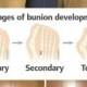 How To Prevent And Treat Bunions