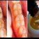 Reverse Cavities Naturally And Heal Tooth Decay With THIS Powerful Tooth Mask