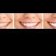 What is White Light Smile&its Uses?