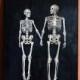 skeleton art love painting couple canvas wall art,life death acrylic canvas painting,halloween gothic art anatomy human skeleton dark art