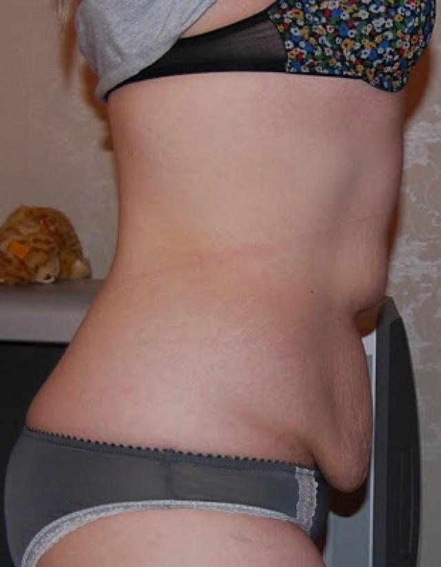 Loose Skin On Belly After Weight Loss