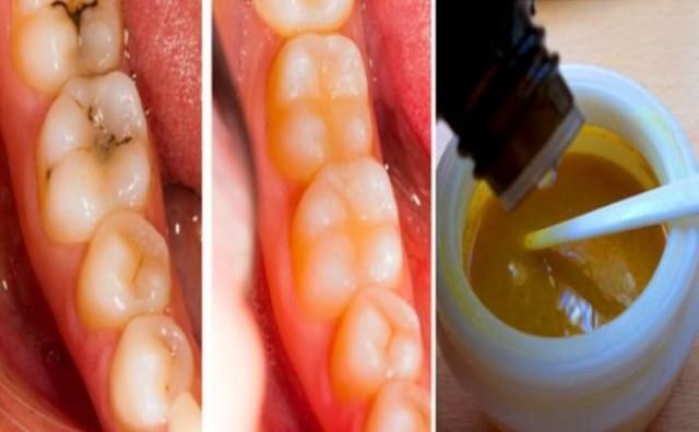 Reverse Cavities Naturally And Heal Tooth Decay With THIS Powerful Tooth Mask