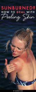 Sunburned? How to Deal With Peeling Skin