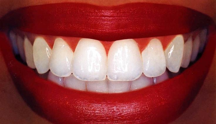Mariage - Comment blanchir les dents avec du peroxyde d'hydrogène