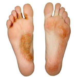 Hochzeit - Natürliche Heilmittel für Fußpilz