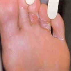 Wedding - Home Remedies For Athlete’s Foot 