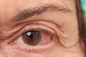 Mariage - Colloidal Silver For Pink Eye