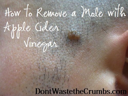 Hochzeit - How To Remove A Mole With Apple Cider Vinegar