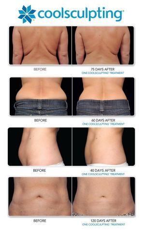 Свадьба - How Much Does Coolsculpting Cost?