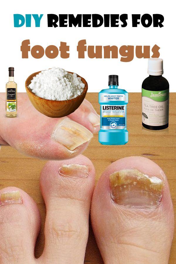 Mariage - DIY Remedies For Foot Fungus