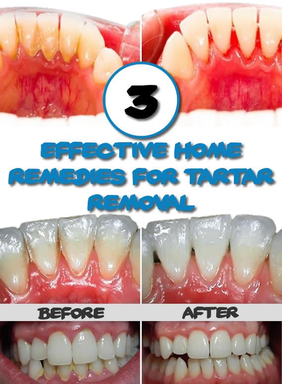 Mariage - 3 Effective Home Remedies For Tartar Removal