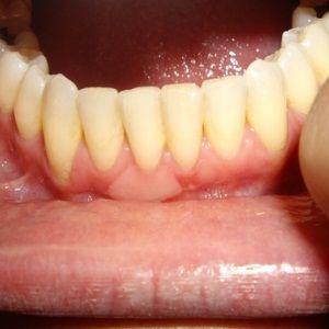 Mariage - Natural Remedies For Receding Gums