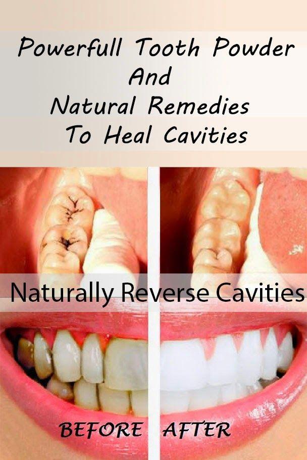 زفاف - Health Matters: How To Heal Cavities Naturally