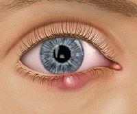 Wedding - 7 Things To Know About An Eye Stye