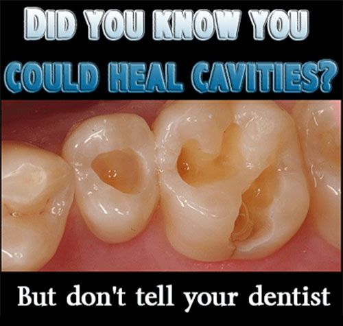 زفاف - How To Heal Cavities Naturally