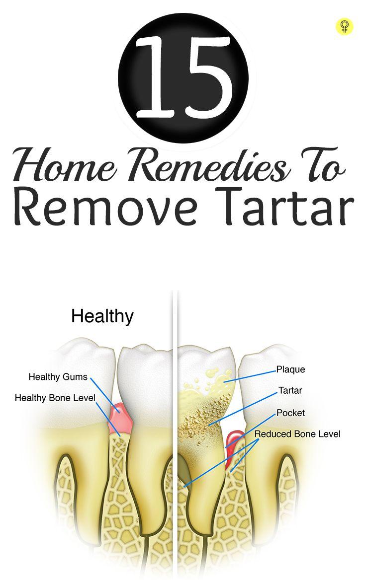 Hochzeit - 15 Amazing Home Remedies To Remove Tartar