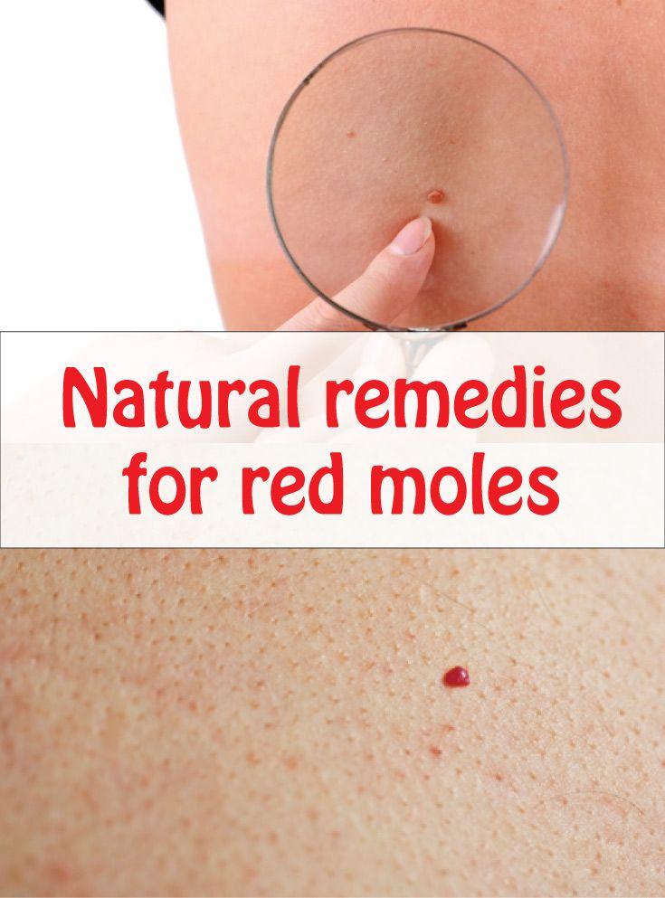Hochzeit - Natural Remedies For Red Moles
