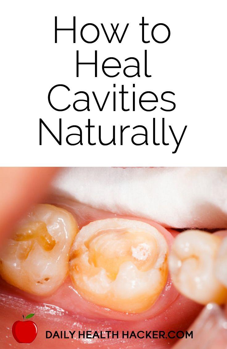 Mariage - How To Heal Cavities Naturally - Daily Health Hacker