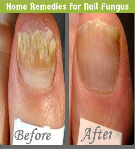Mariage - Home Remedies For Nail Fungus