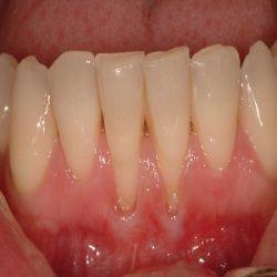 Mariage - Top 7 Cures To Receding Gums