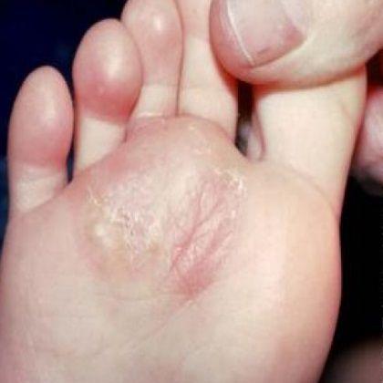 Hochzeit - Top 10 Home Remedies For Foot Fungus - Natural Treatments For Foot Fungus