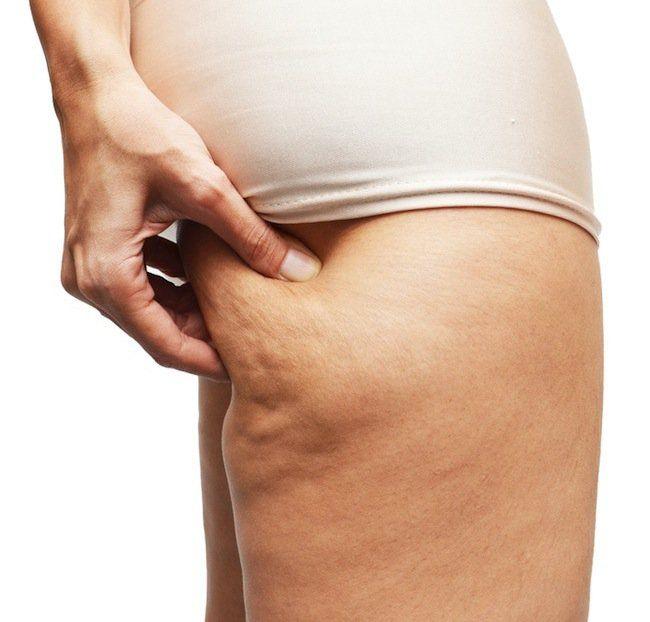 Mariage - Get Rid Of Cottage Cheese Thighs