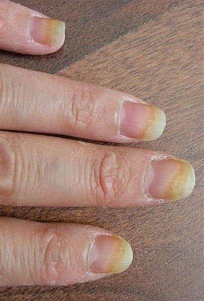 Mariage - Best Home Remedies For Nail Fungus
