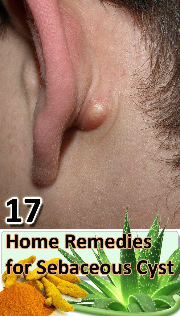Hochzeit - 17 Home Remedies For Sebaceous Cyst