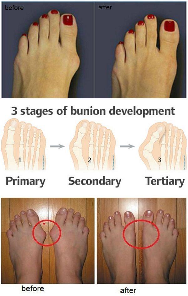 Hochzeit - How To Prevent And Treat Bunions