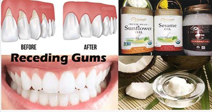 Mariage - The Gum Disease Is A Silent Killer! Here Are 8 Home Remedies To Heal It!