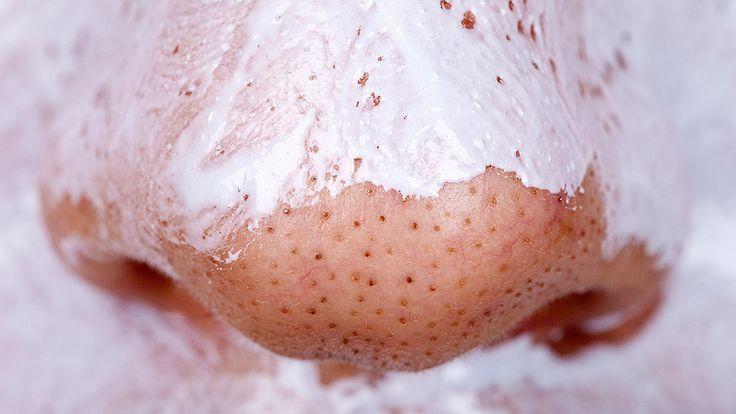 Свадьба - Two Ingredients Are All You Need To Get Rid Of Blackheads Forever