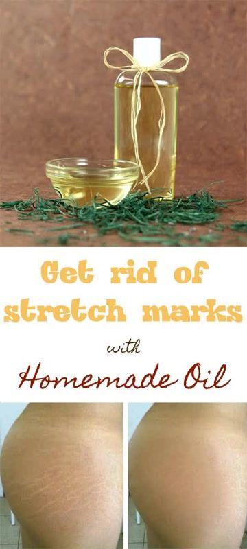 Свадьба - Get Rid Of Stretch Marks With Homemade Oil