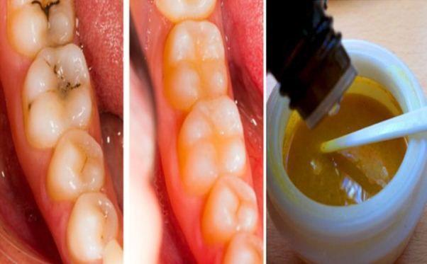 Mariage - Reverse Cavities Naturally And Heal Tooth Decay With THIS Powerful Tooth Mask