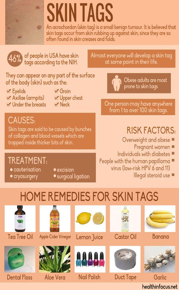 Hochzeit - 10 Surprising Home Remedies For Skin Tags Plus Ways To Reduce Your Risk Of Getting Them