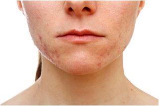 Wedding - How To Remove Pimples On Chin? - Ladiestylelife.com