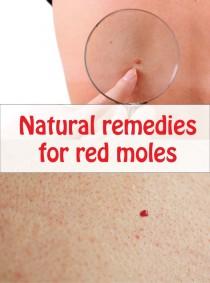 wedding photo - Natural Remedies For Red Moles