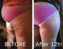 wedding photo - How To Get Rid Of Cottage Cheese Thighs 