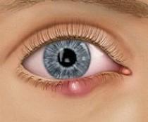 wedding photo - 7 Things To Know About An Eye Stye