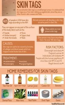 wedding photo - 10 Surprising Home Remedies For Skin Tags Plus Ways To Reduce Your Risk Of Getting Them